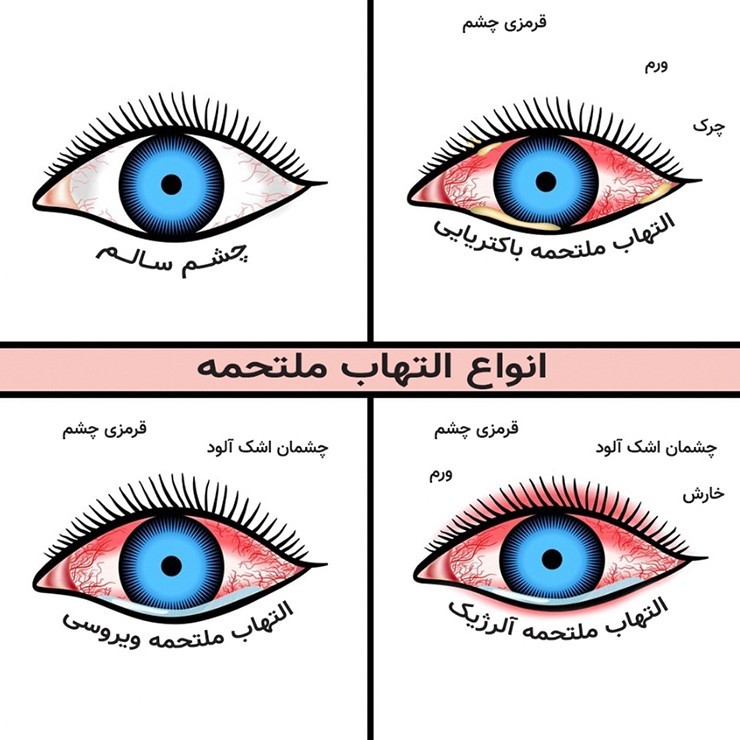 درک و شناسایی مشکل چشمی التهاب ملتحمه