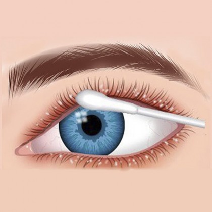 همه چیز در مورد بلفاریت یا التهاب پلک چشم