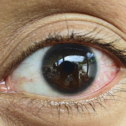 جلوگیری از آلودگی و عفونت چشم ها